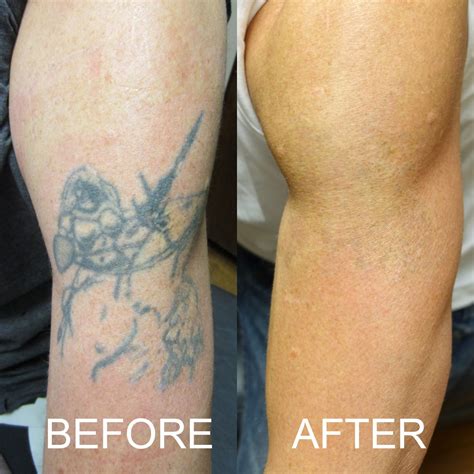 Before And After Tattoo Removal Before And After Tattoo Removal