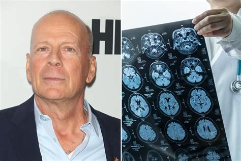 Bruce Willis Disease: Unraveling the Mystery Behind the Actor's Condition