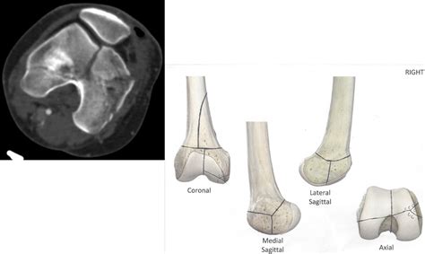 Intra Articular Fracture: Unraveling the Silent Culprit Behind Joint Pain