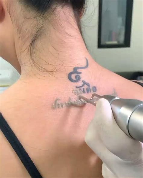 Is Laser Tattoo Removal Expensive And Other Removal Options Artofit