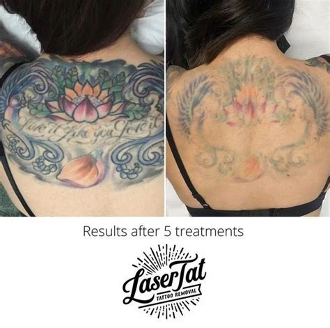 Laser Tattoo Removal How Long Until You Can See Results Lasertat