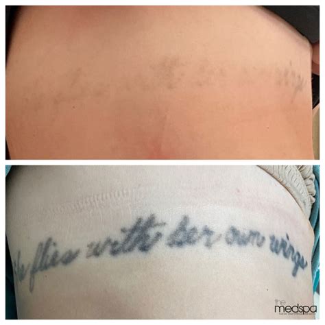 Laser Tattoo Removal In New Smyrna Beach Fl The Med Spa Of Smyrna Beach