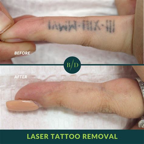 List 103 Pictures Before And After Pictures Of Laser Tattoo Removal Sharp