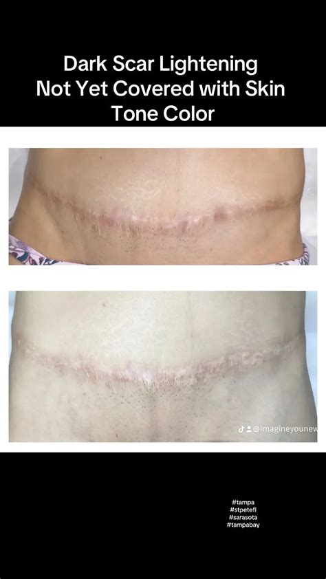 Mastering Tummy Tuck Tattoo Cover Up Achieving Flawless Results With