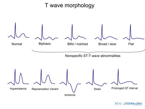 Non Specific T Wave Abnormality: Understanding Its Causes and Implications