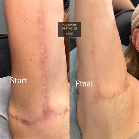 Paramedical Tattoo Scar Camouflage Paramedicaltattoodallas