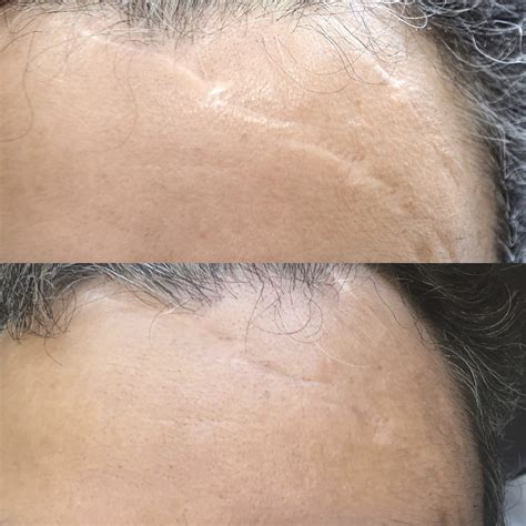 Scar Camouflage Tattoo Danielle Scott Gold Coast Australia