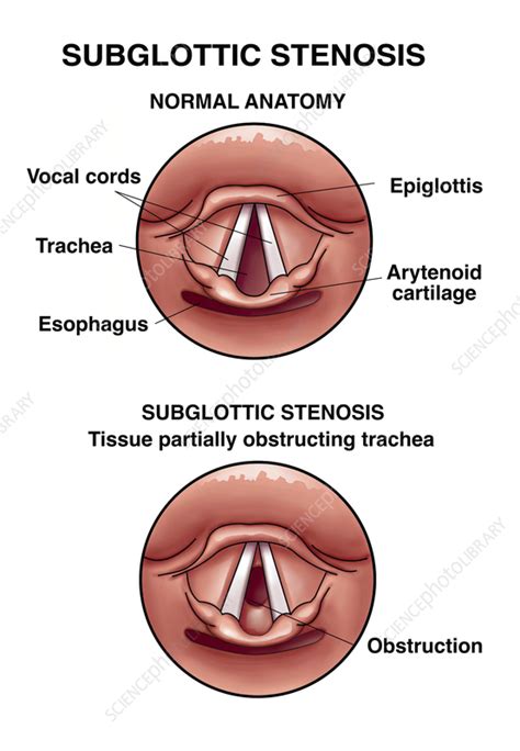 Subglottic Stenosis: Unraveling Mysteries for Better Breathing