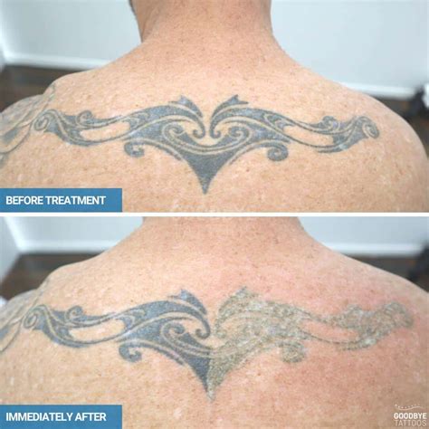 Tattoo Removal Before And After Goodbye Tattoos Sydney