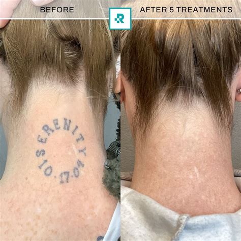 Tattoo Removal Results