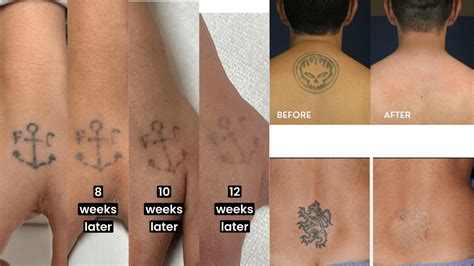 Tattoo Removal What To Expect From Laser Treatments