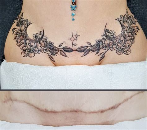 Tummy Tuck Scar Tattoo Artofit Tummy Tuck Scar Tattoo Artofit