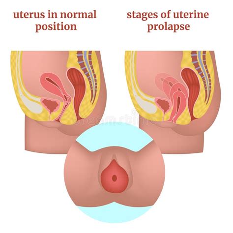 Urethral Prolapse: Causes, Symptoms Unveiled