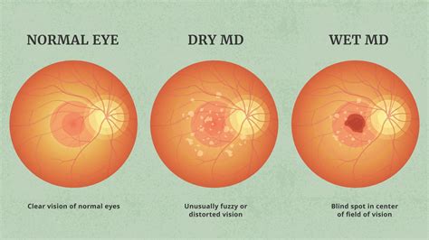 Unlocking Wet Age-Related Macular Degeneration Mystery